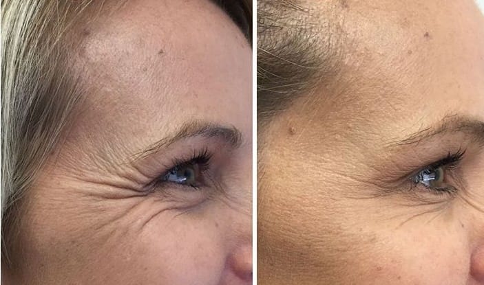 p botox