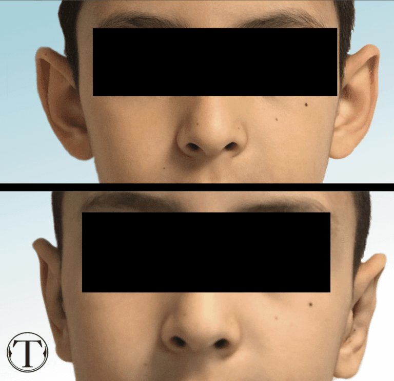 otoplastyka