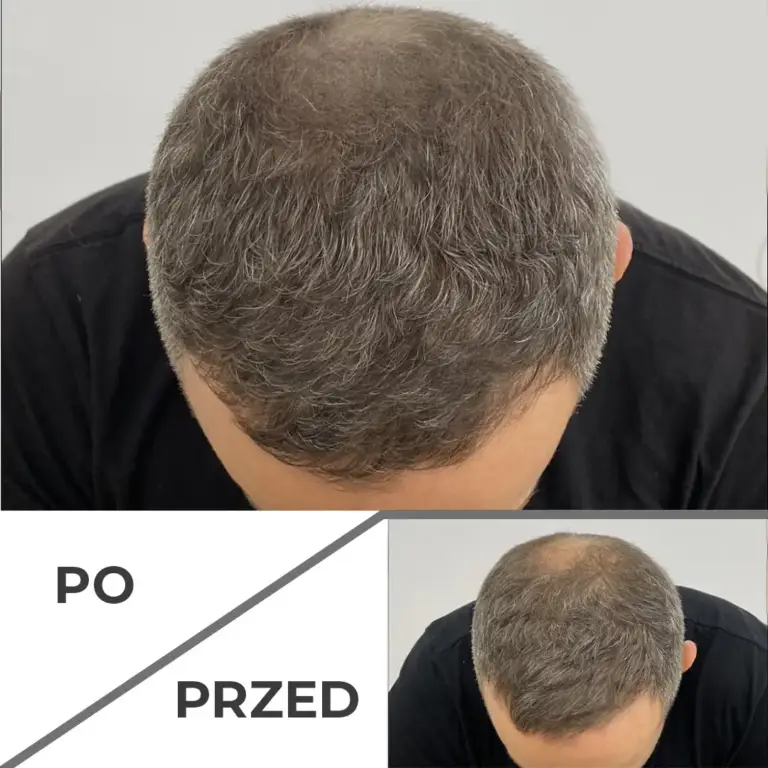 Mikropigmentacja skóry głowy wrocław 2