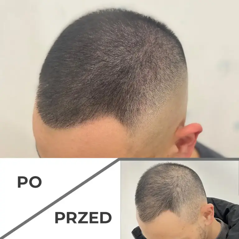Mikropigmentacja skóry głowy wrocław 3