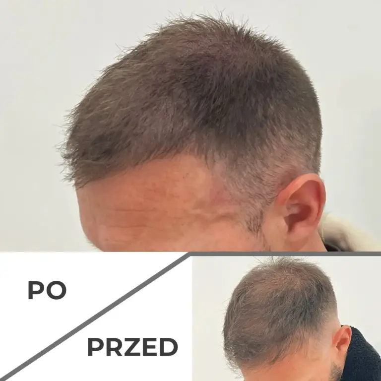 Mikropigmentacja skóry głowy wrocław 4
