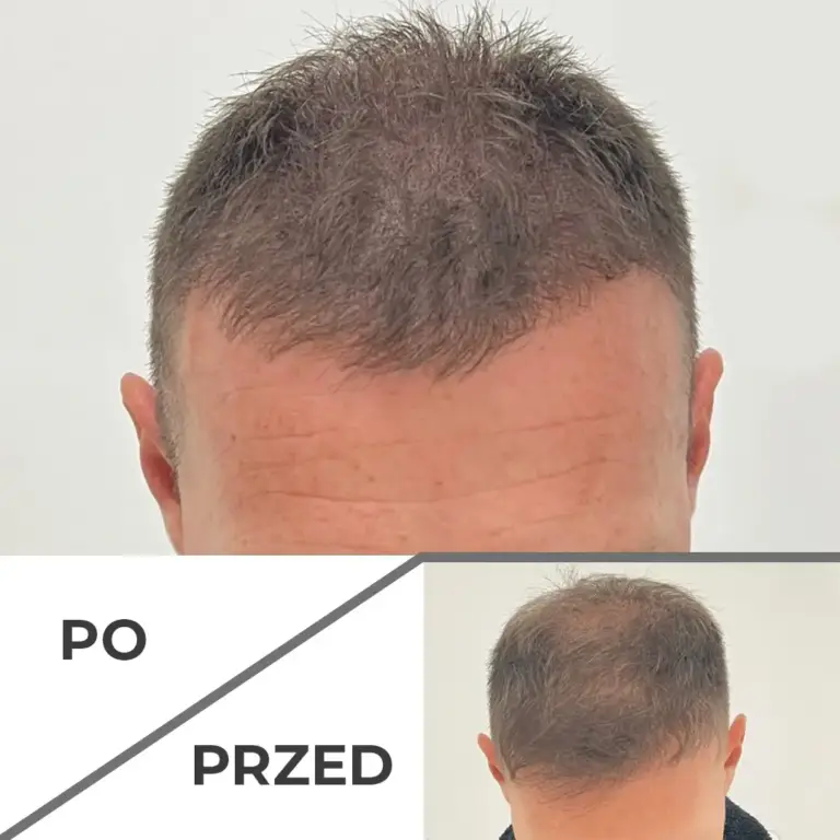 Mikropigmentacja skóry głowy wrocław 5
