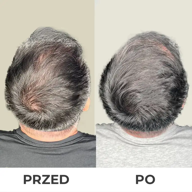 Mikropigmentacja skóry głowy wrocław 7