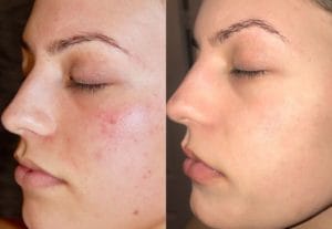 Perfect-Derma-Peel