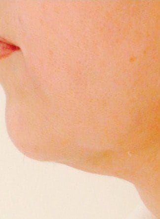 endolift