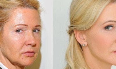 Lipotransfer
