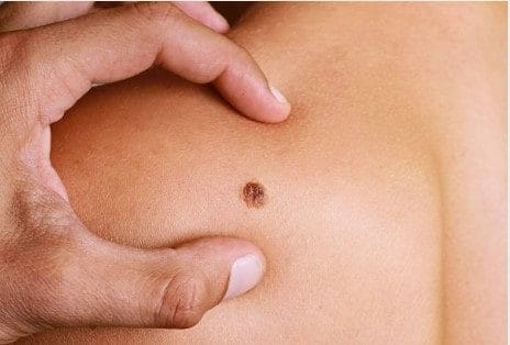 laserowe usuwanie pieprzyków i brodawek