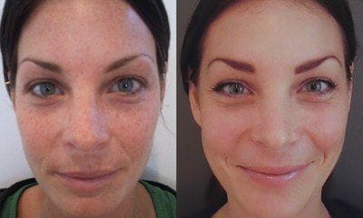 Perfecta derma peel