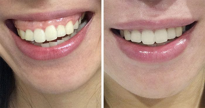Gummy-Smile-Botoks-Wrocław